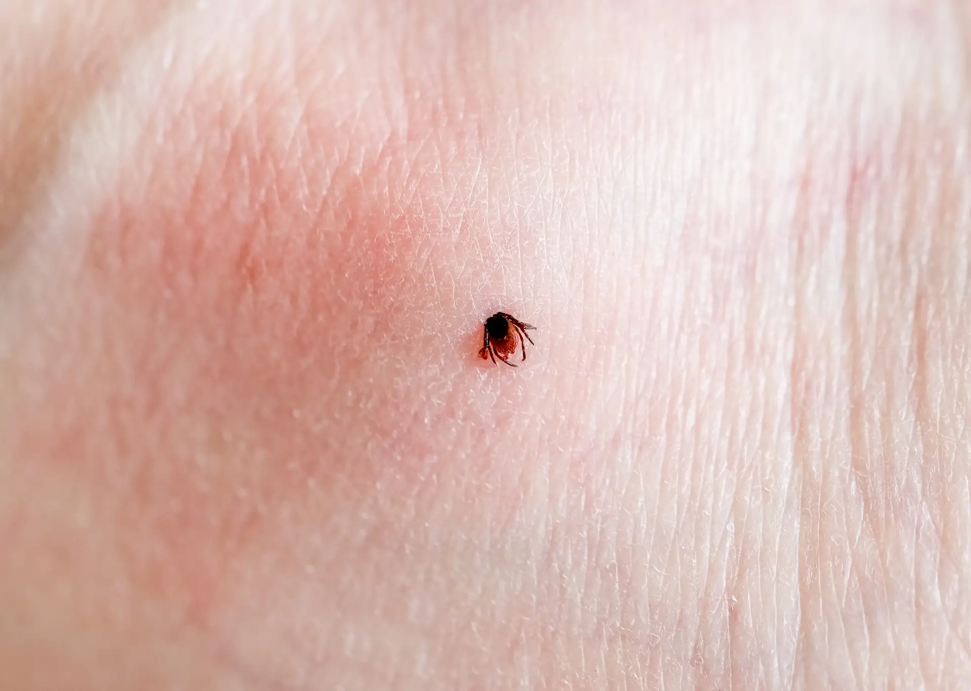 a tick embedded in a person skin 2025 03 07 08 08 37 utc scaled